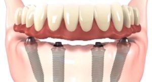 Dental Implants Dentist Near Me Nassau County, NY